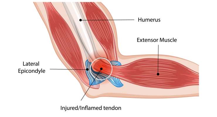 Epicondylitis Golferellenbogen oder Tennisellenbogen. Behandlung in München durch Prof. Dr. med. Martetschläger
