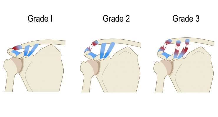 AC-Gelenksluxation - Verletzung des Schultereckgelenks. Behandlung in München durch Prof. Dr. med. Martetschläger