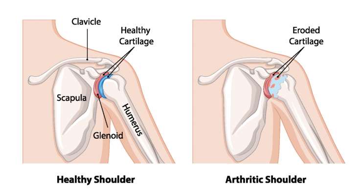 Arthrose ACG - Knorpelverschleiß im Schultereckgelenk. Behandlung in München durch Prof. Dr. med. Martetschläger