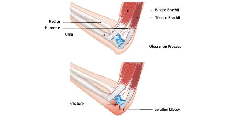 Ellenbogenbruch. Behandlung in München durch Prof. Dr. Med. Martetschläger