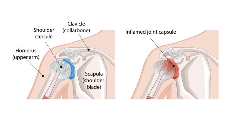 Frozen-Shoulder - schmerzhafte Schultersteife. Behandlung in München durch Prof. Dr. med. Martetschläger