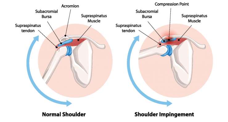Subacromiales Impingement - Schmerzhaftes Engpass-Syndrom unter dem Schulterdach. Behandlung in München durch Prof. Dr. med. Martetschläger