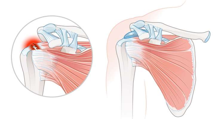 Verletzung der Rotatorenmanschette - Schmerzen und Funktionsverlust der Schulter. Behandlung in München durch Prof. Dr. med. Martetschläger